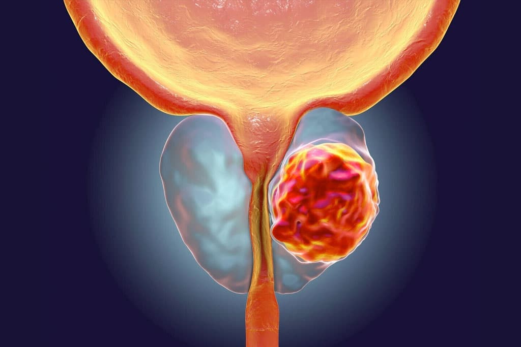Manual Informativo para Pacientes con Cáncer de Próstata
