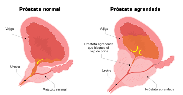 Crecimiento Prostático Obstructivo (CPO)