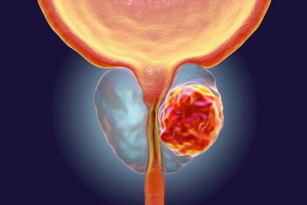 Manual Informativo para Pacientes con Cáncer de Próstata